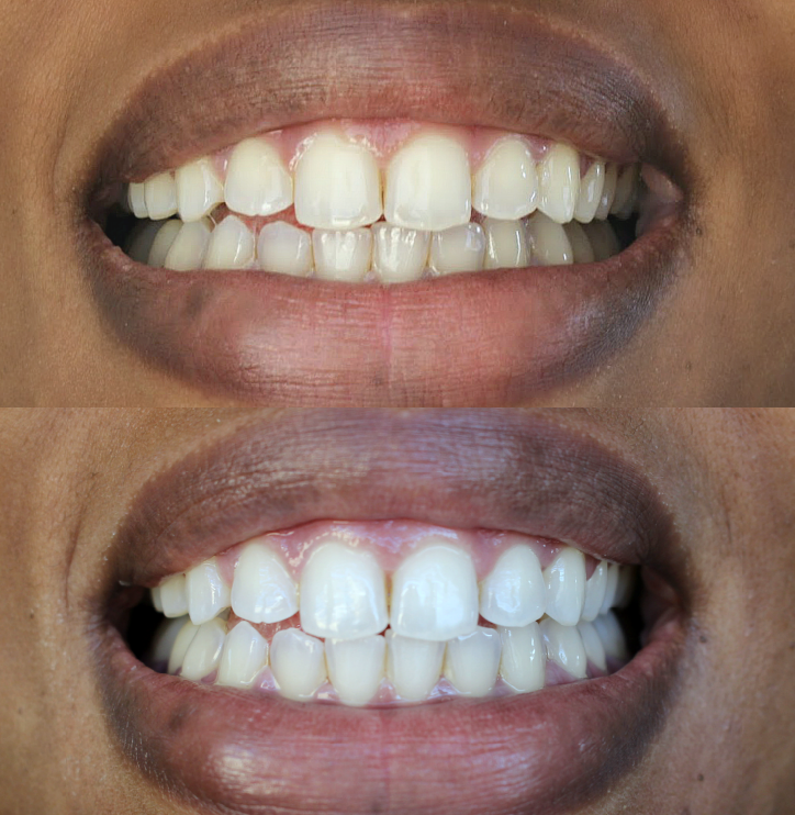 Why I Whitened My Teeth- A Smile Brilliant Review